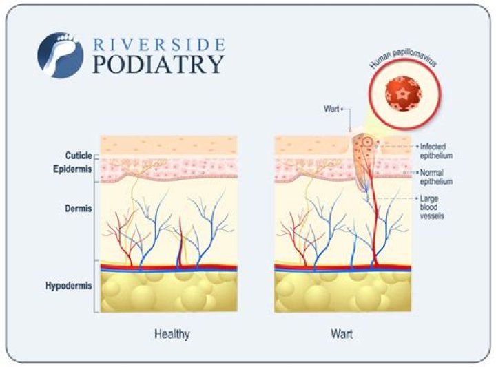 Do warts bleed a lot?