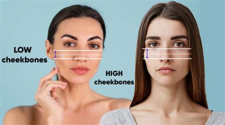 What causes high cheekbones?