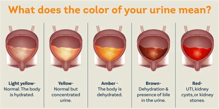 What color is your pee when your liver is failing?